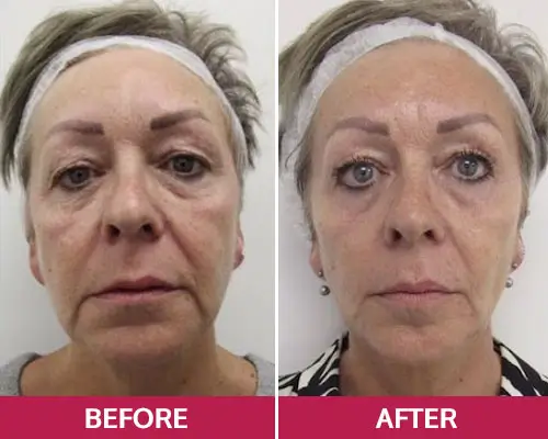 Lynn Thomas, 56 (Florida)